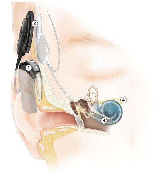 What's a Cochlear Implant – Wickramarachchi Opticians
